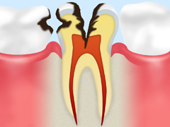 C3（歯髄の虫歯）