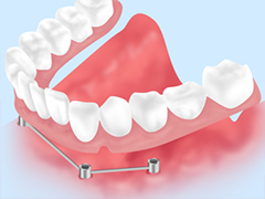 インプラントオーバーデンチャー