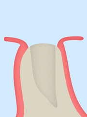 1：歯茎の切開