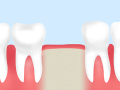 失った歯を放置することで起きるデメリット