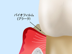 軽度の歯周病