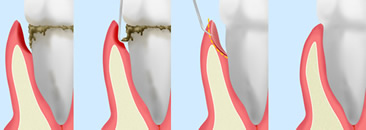 歯周ポケット掻爬（そうは）